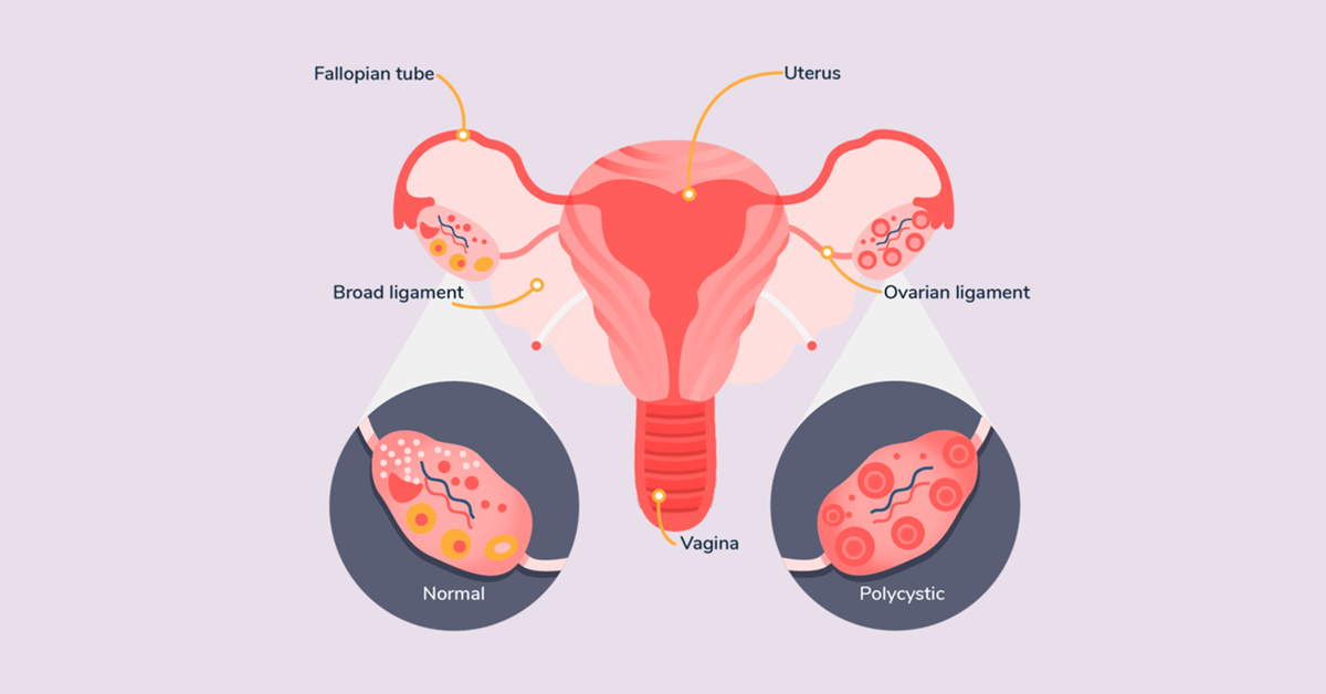 The Ultimate Guide to PCOS: Meaning, Symptoms, Causes, and Modern Treatment Breakthroughs